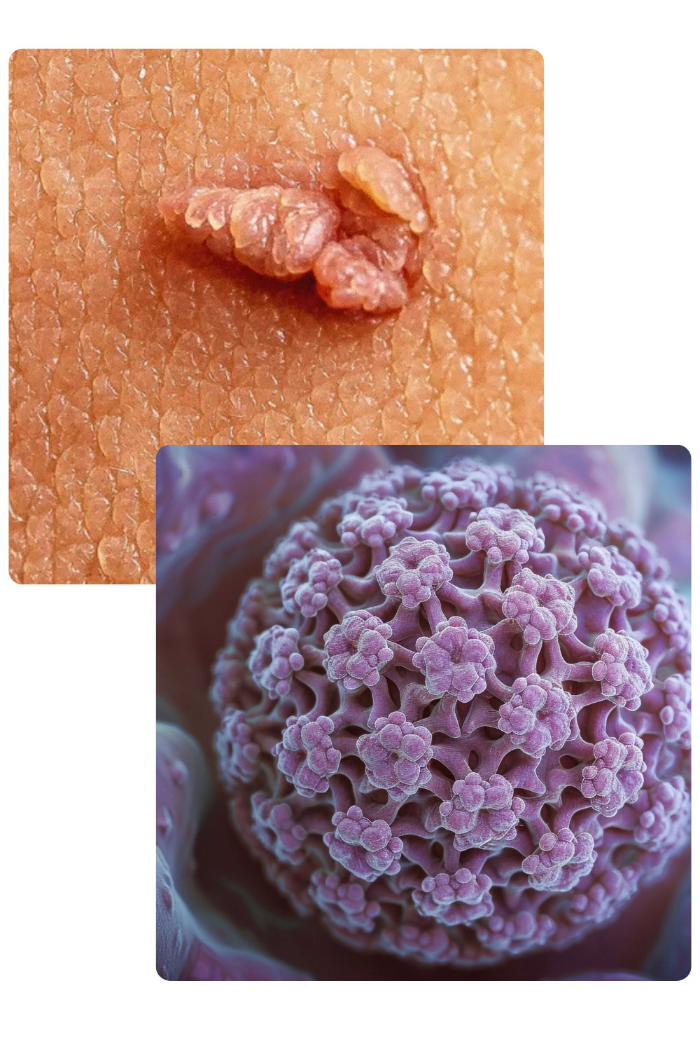 Tratamiento para VPH en Córdoba, Veracruz